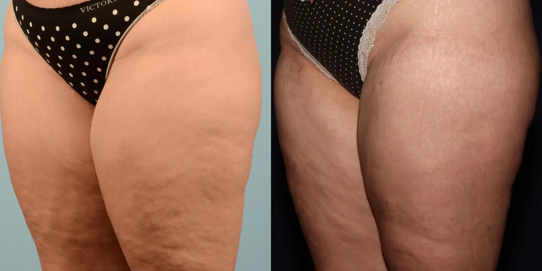 Liposuction: Patient 17 - Before and After 5