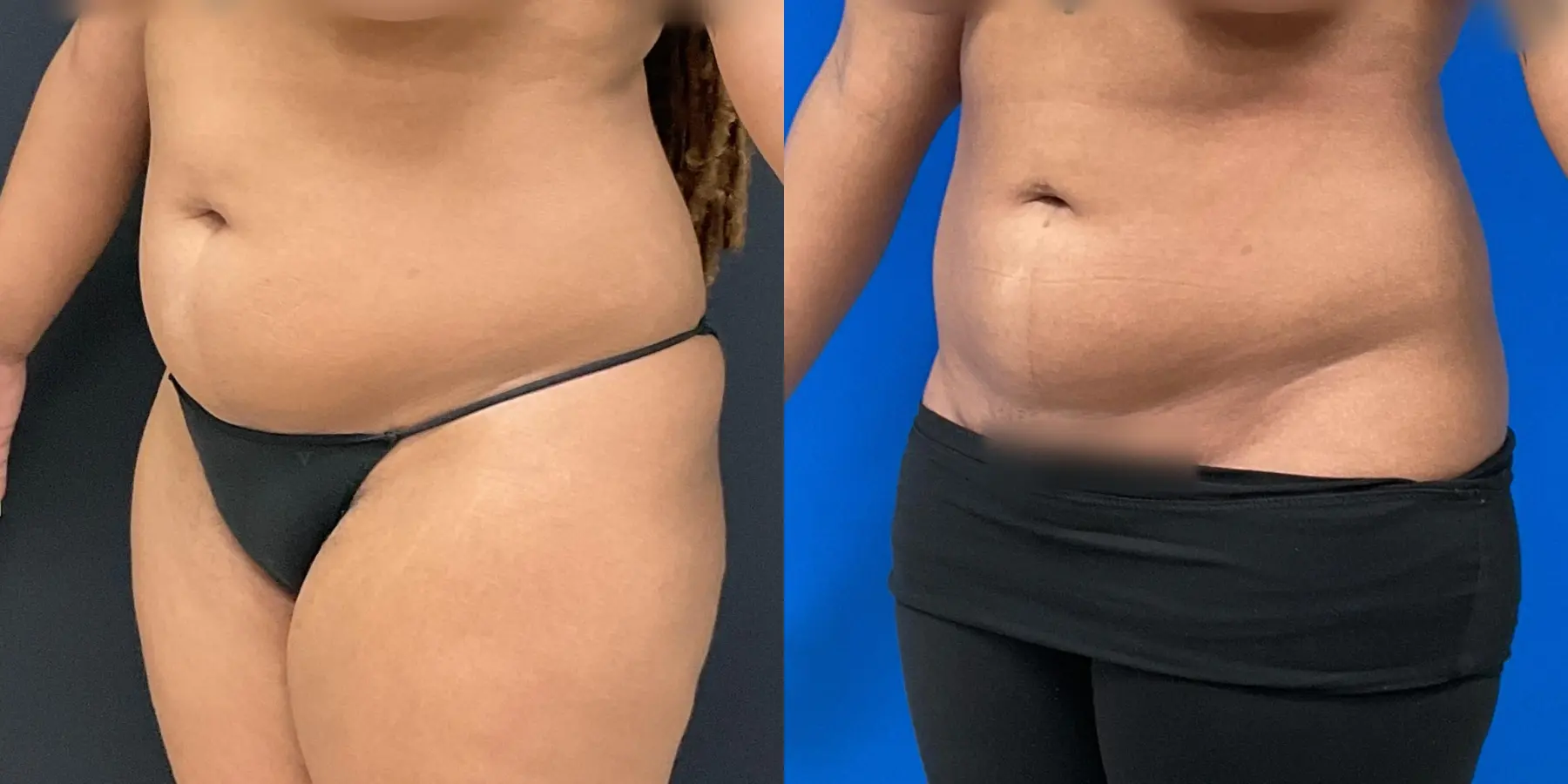 Liposuction: Patient 2 - Before and After 2