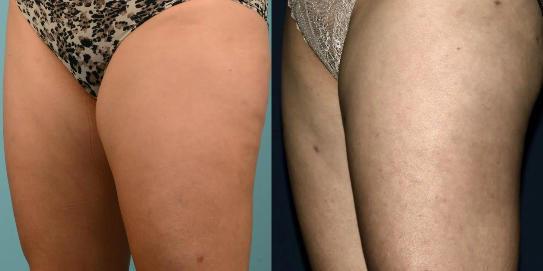 Liposuction: Patient 1 - Before and After 2