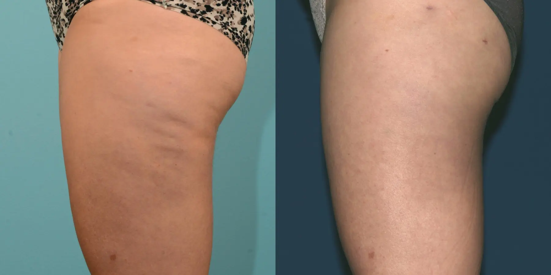 Liposuction: Patient 1 - Before and After 4