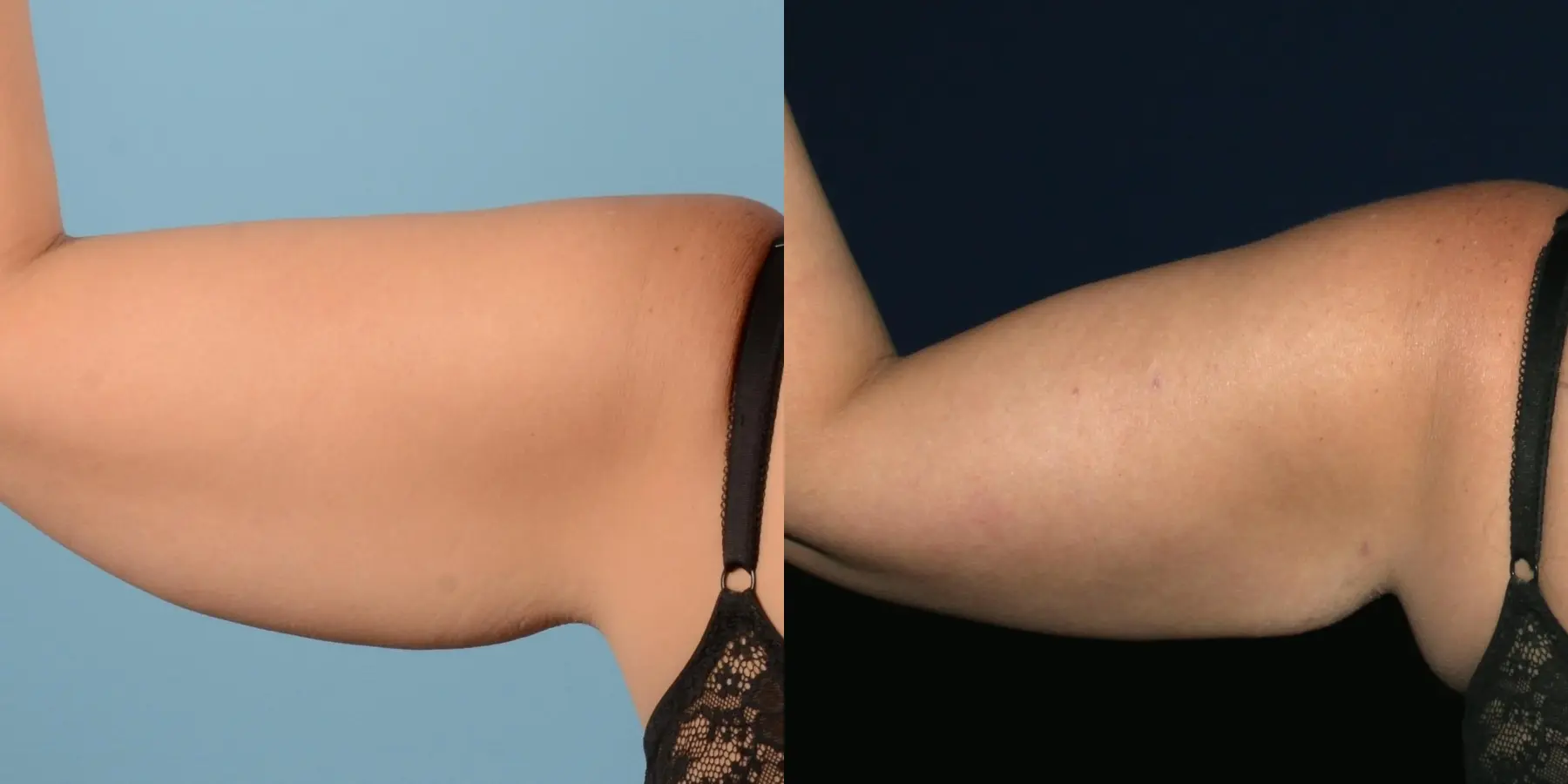 Liposuction: Patient 17 - Before and After 7