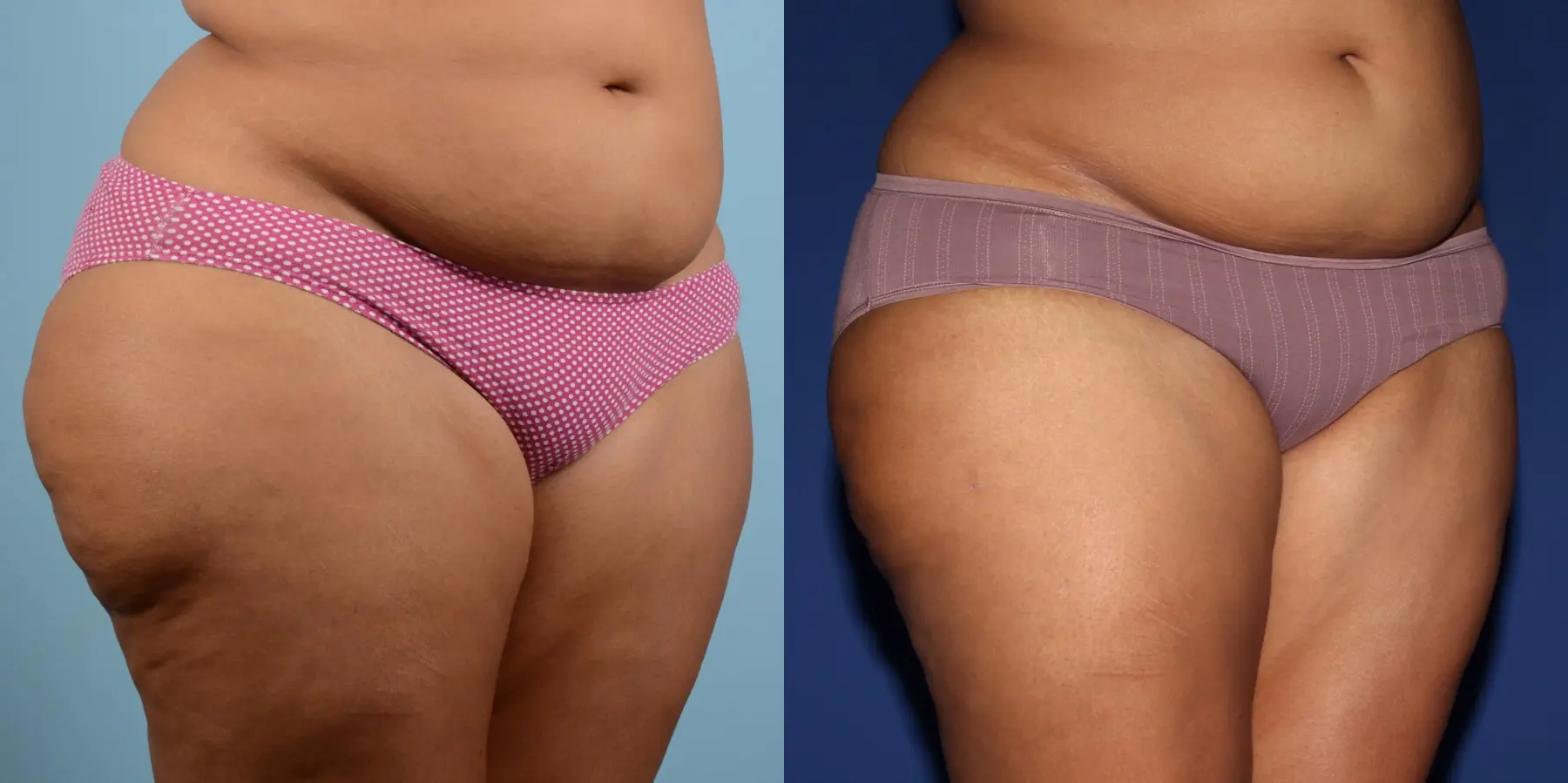 Liposuction: Patient 8 - Before and After 3