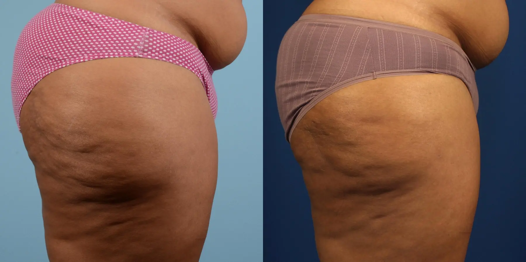 Liposuction: Patient 8 - Before and After 7