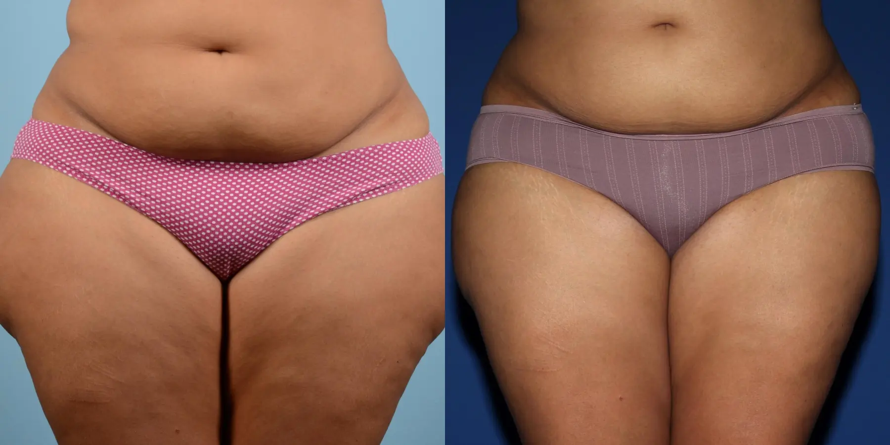 Liposuction: Patient 16 - Before and After  