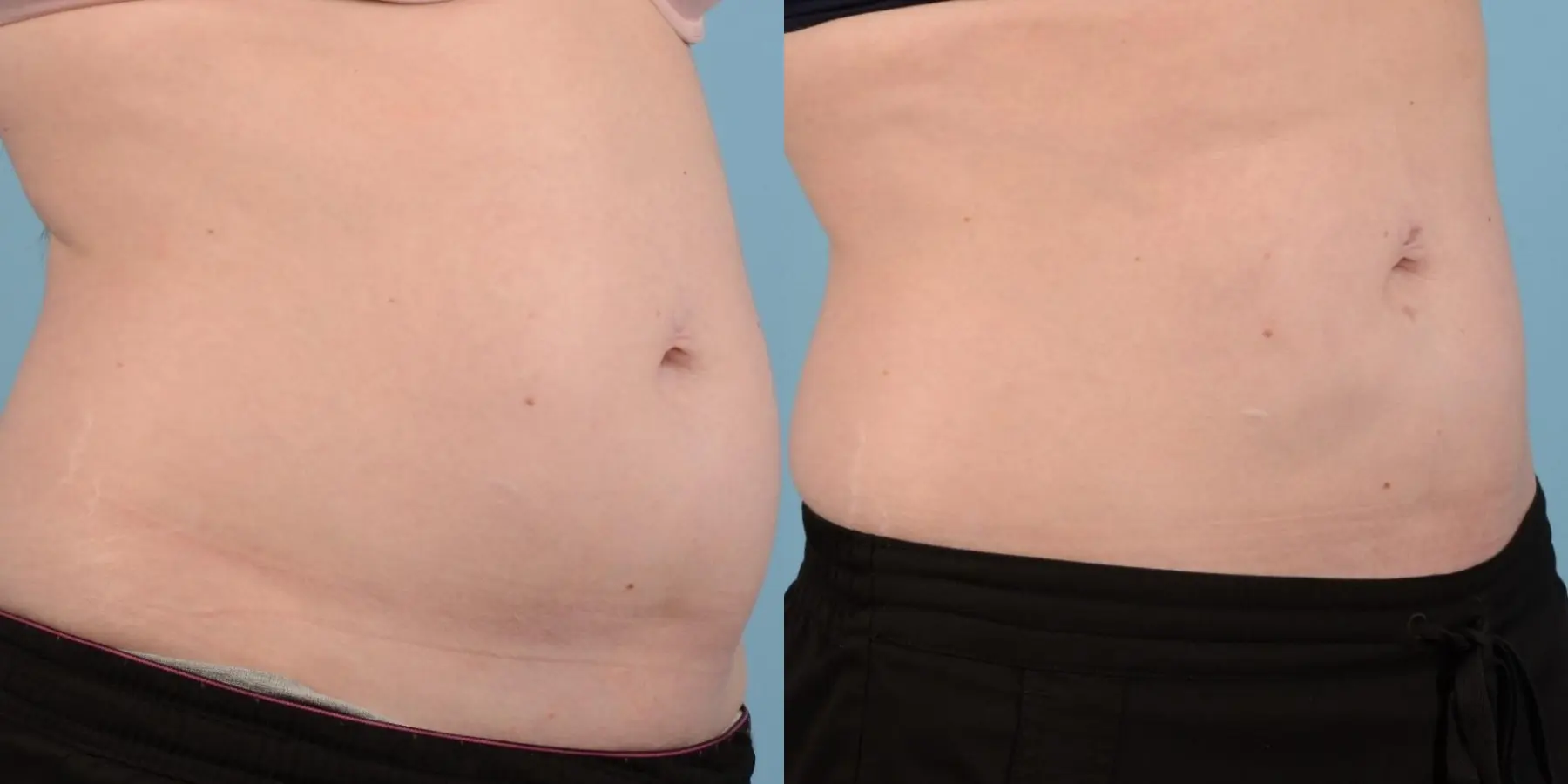 Liposuction: Patient 6 - Before and After 3