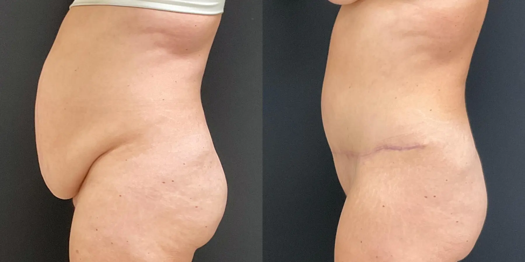 Liposuction: Patient 4 - Before and After 4