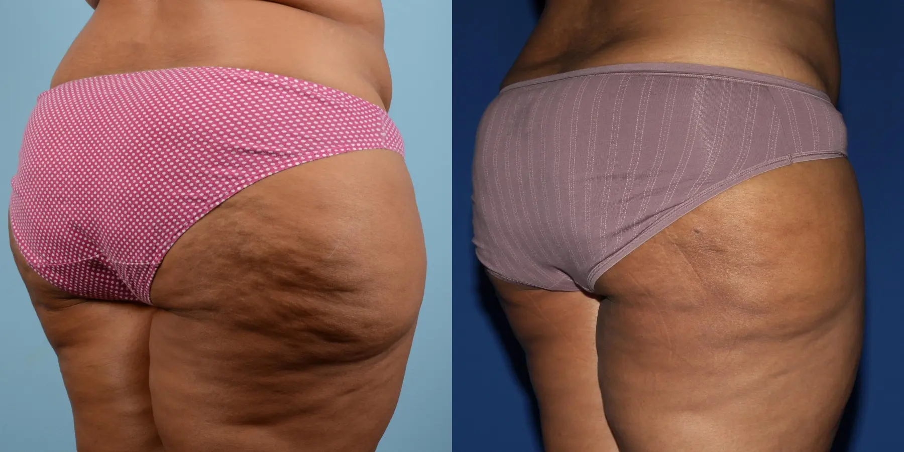 Liposuction: Patient 8 - Before and After 5