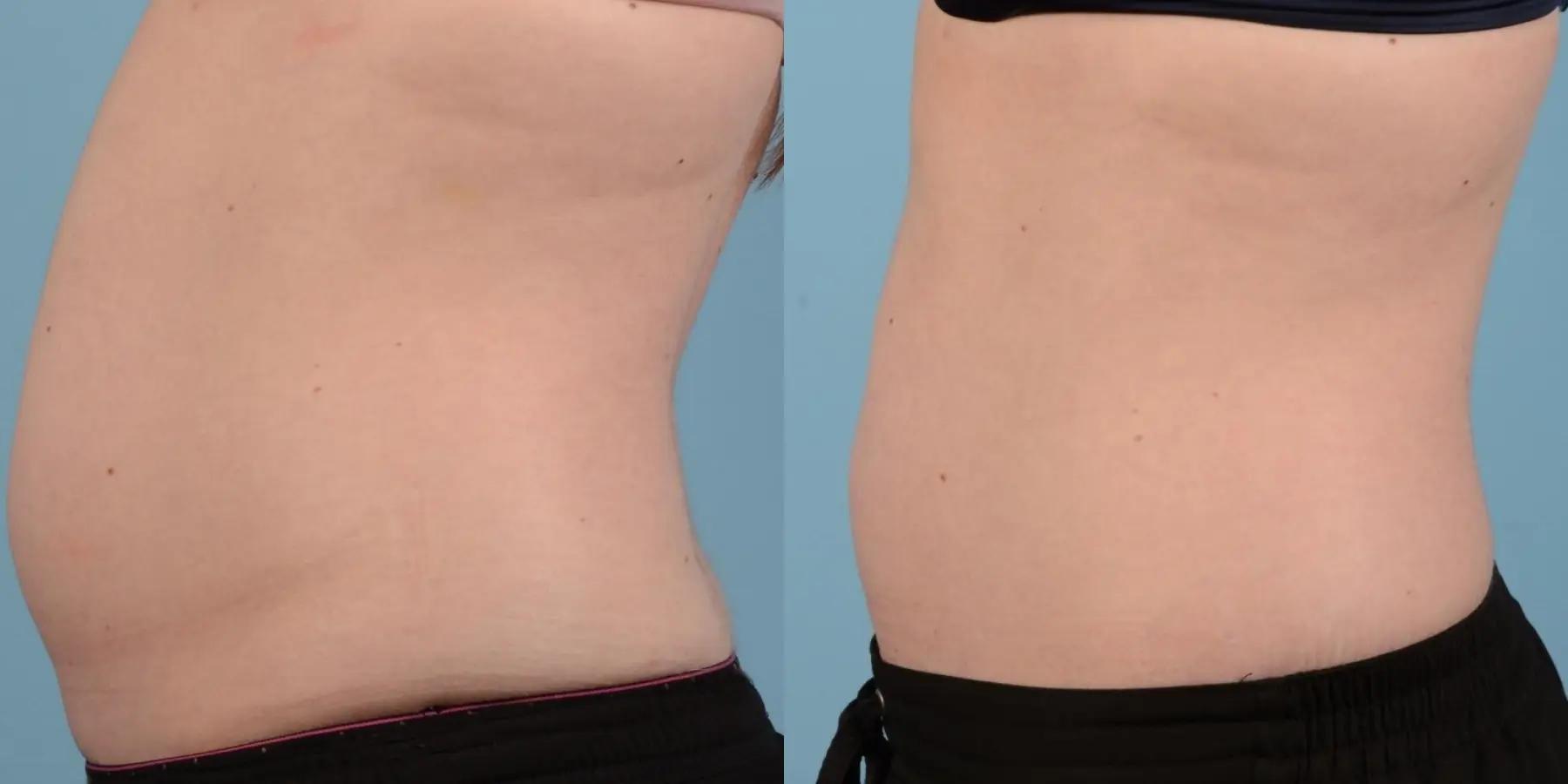 Liposuction: Patient 6 - Before and After 4