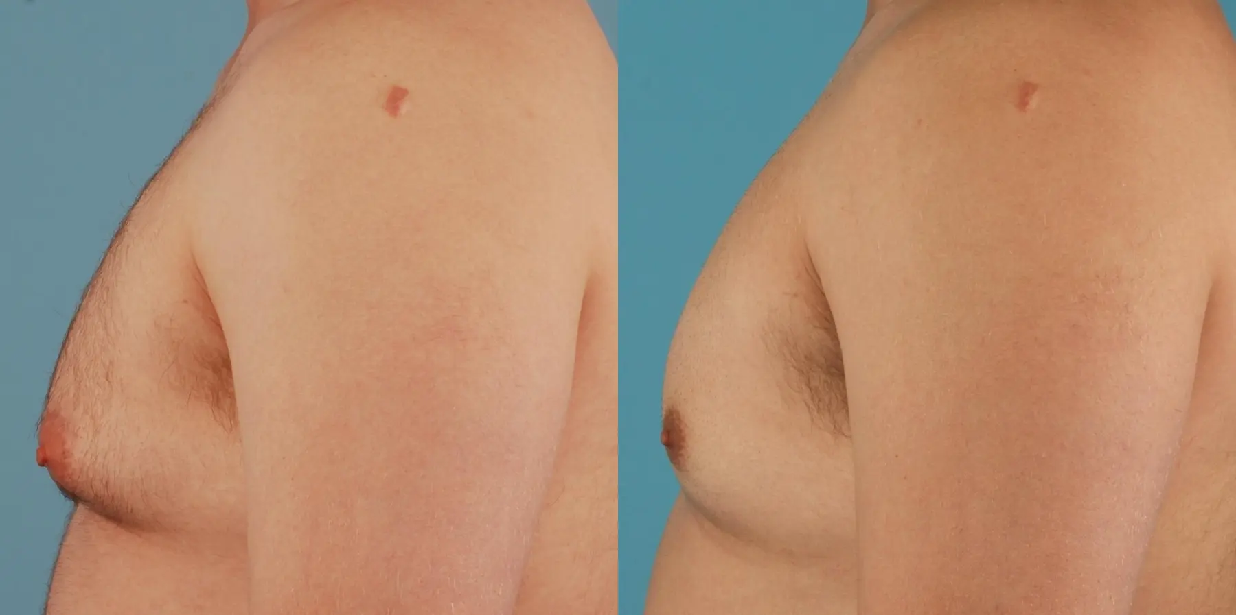 Liposuction For Men: Patient 3 - Before and After 4