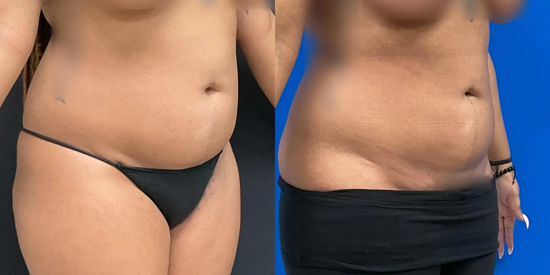 Liposuction: Patient 2 - Before and After 3