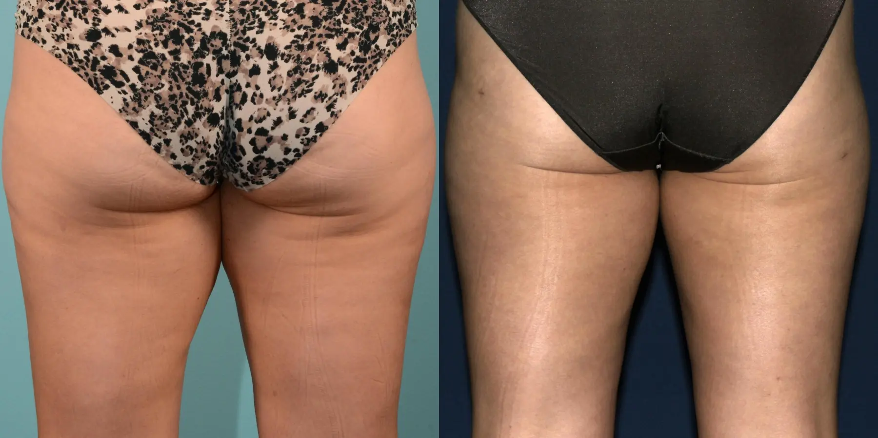 Liposuction: Patient 1 - Before and After 6