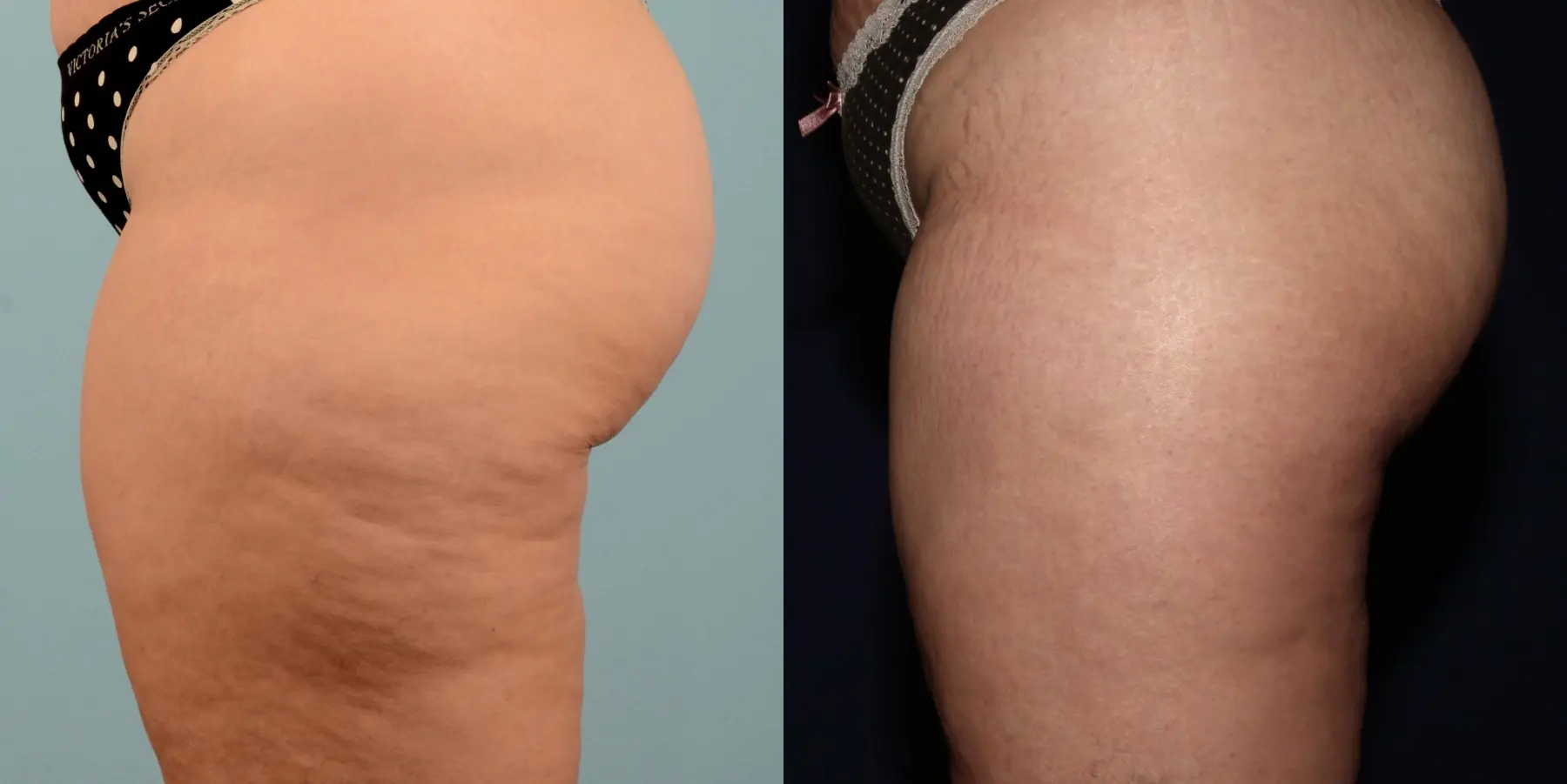 Liposuction: Patient 17 - Before and After 4