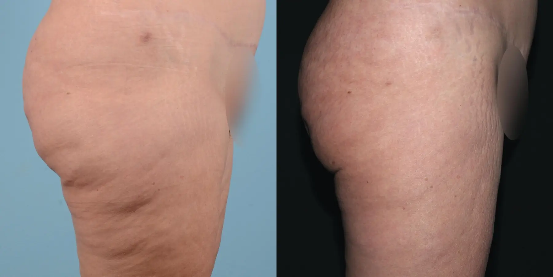 Liposuction: Patient 7 - Before and After 4