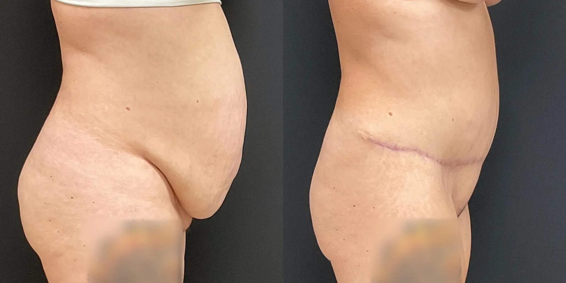 Liposuction: Patient 4 - Before and After 5