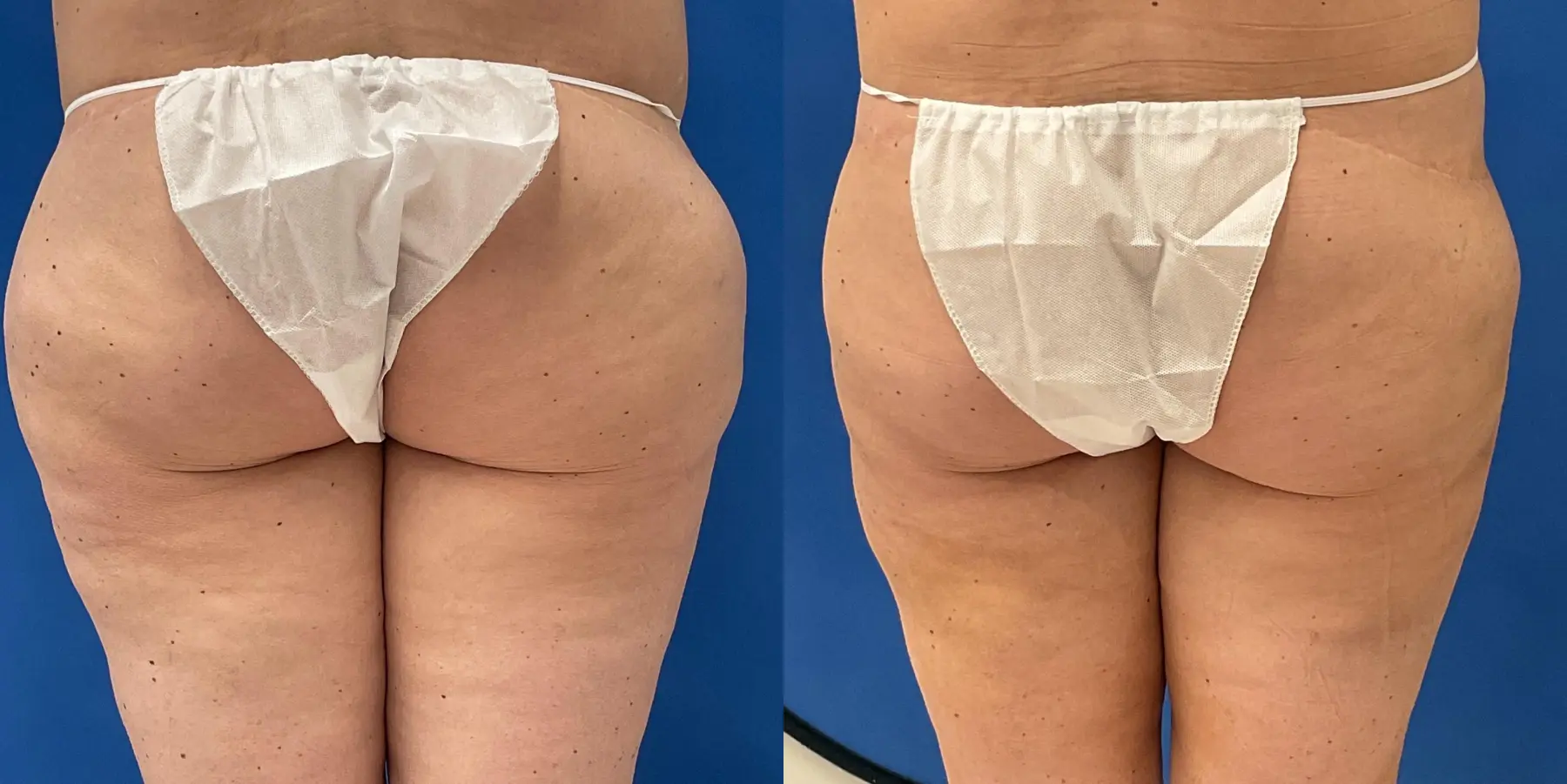 Before and after a liposuction. - Before and After 4