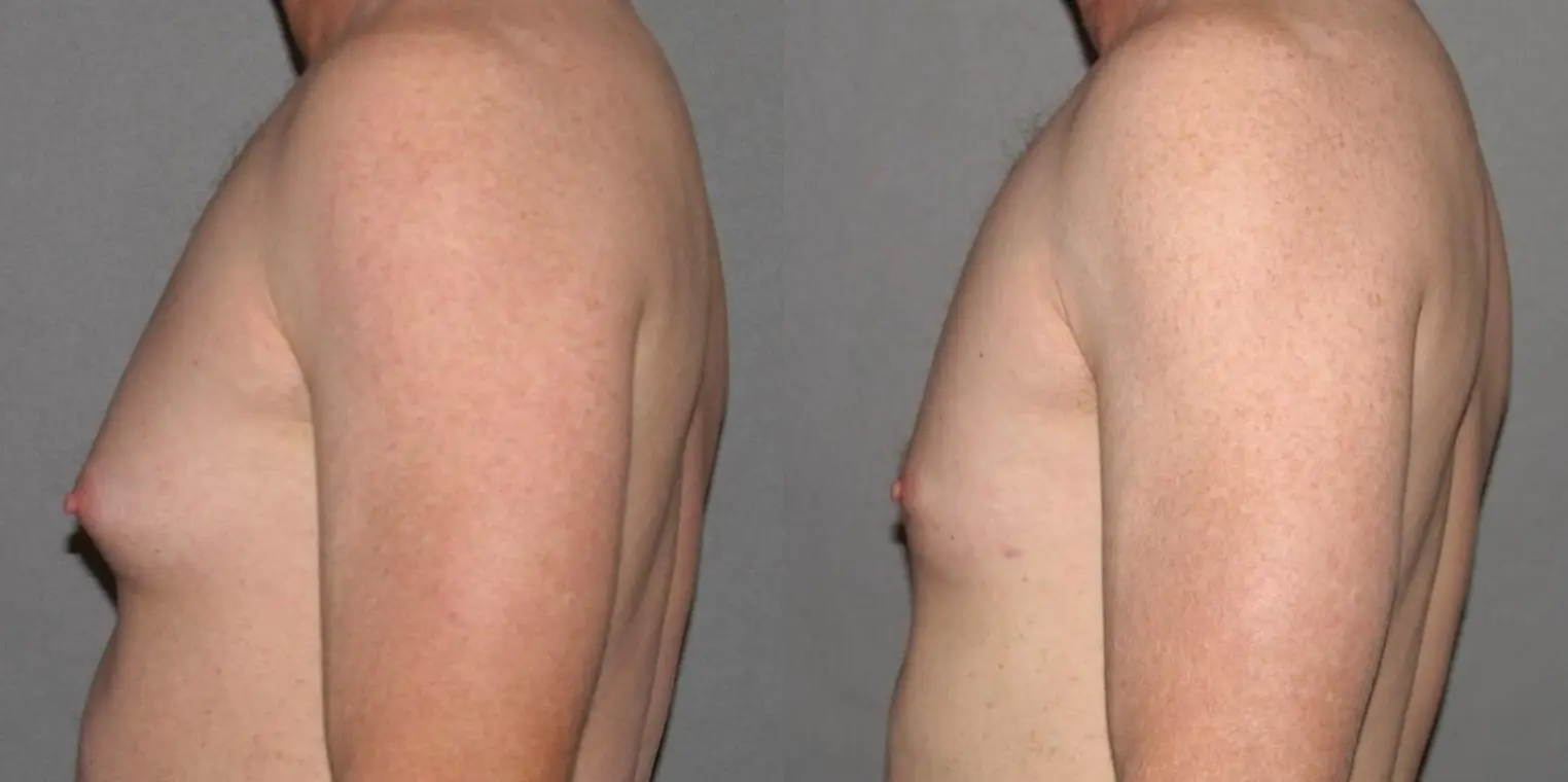 Liposuction For Men: Patient 2 - Before and After 2