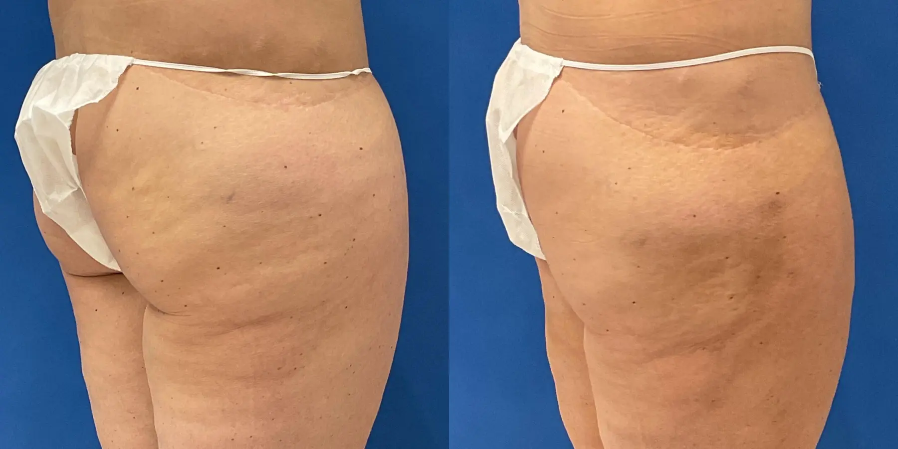 Before and after a liposuction. - Before and After 5