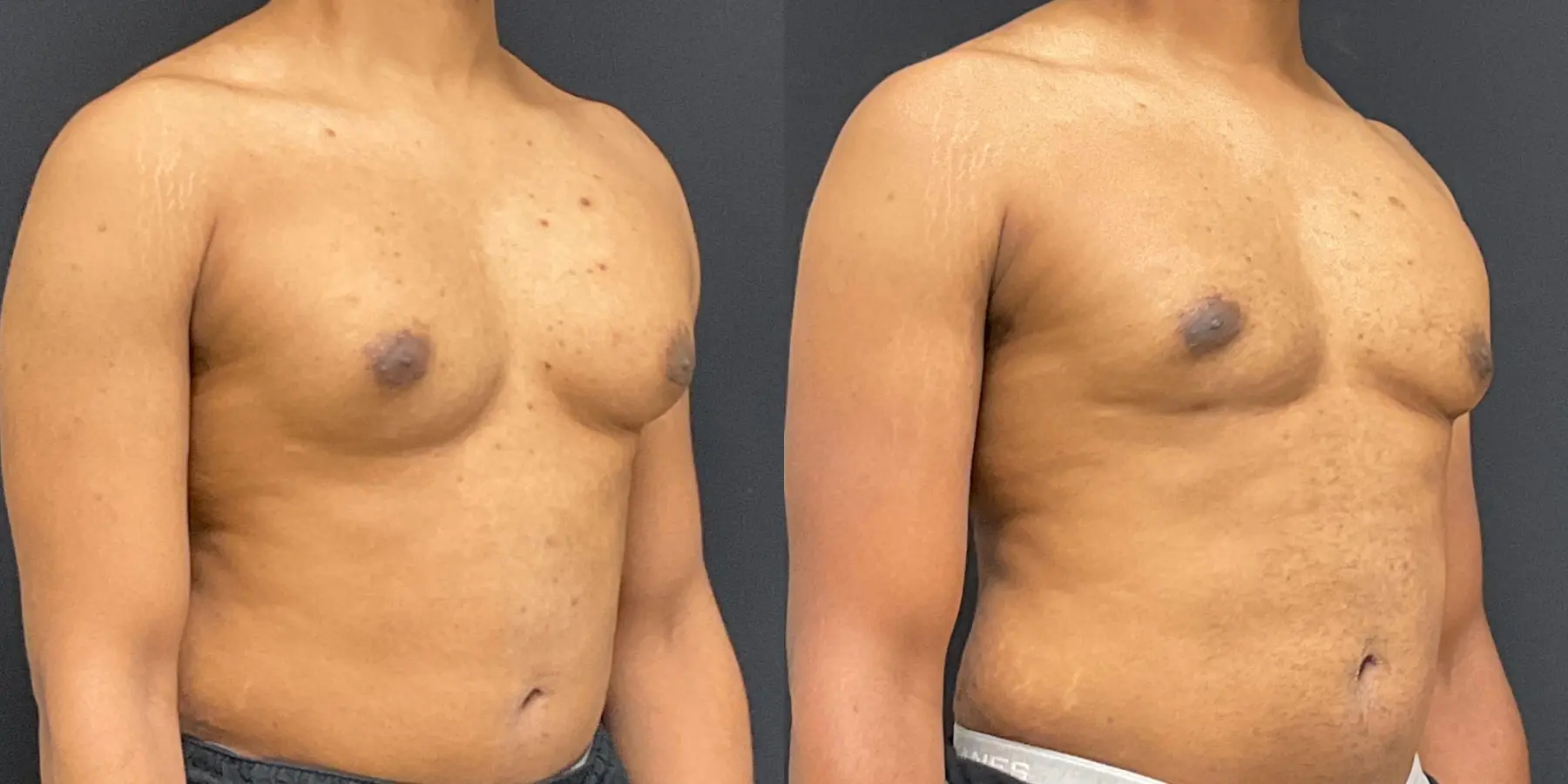 Liposuction For Men: Patient 1 - Before and After 3