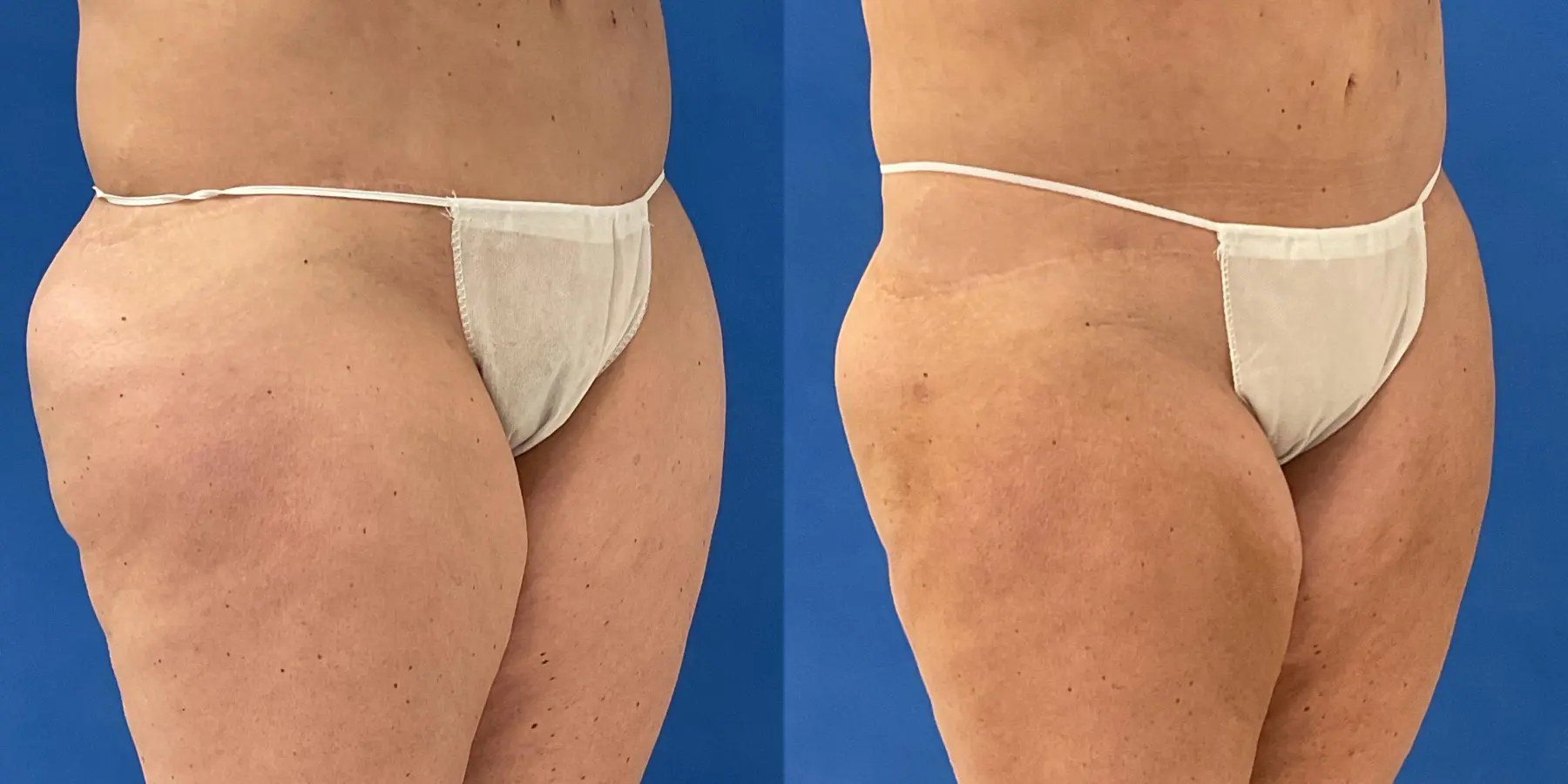 Before and after a liposuction. - Before and After 6