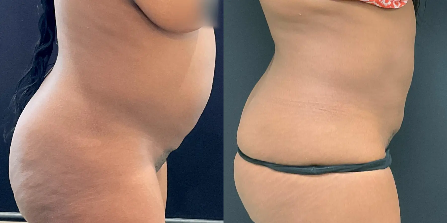 Liposuction: Patient 5 - Before and After 5