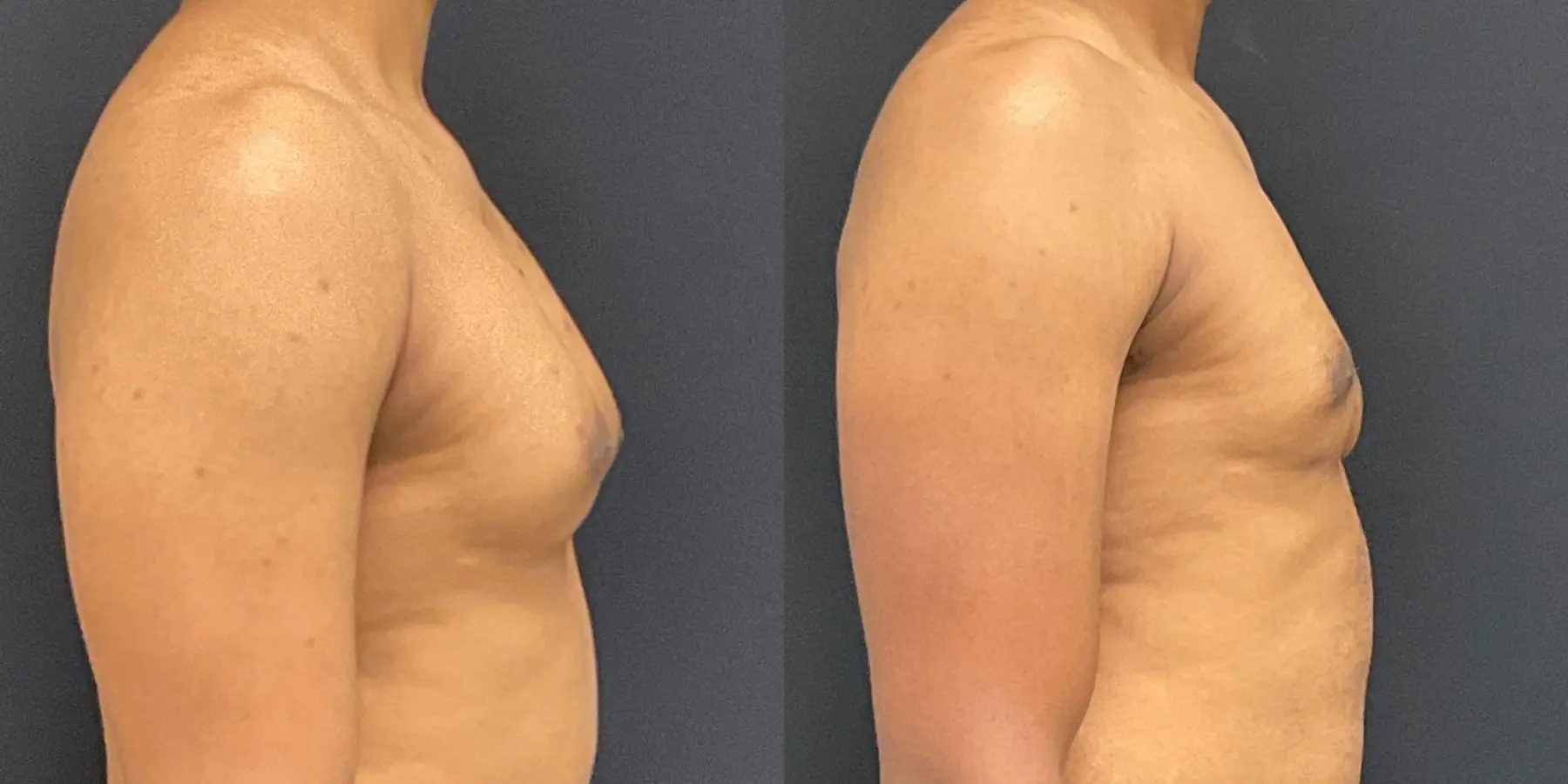 Liposuction For Men: Patient 1 - Before and After 5