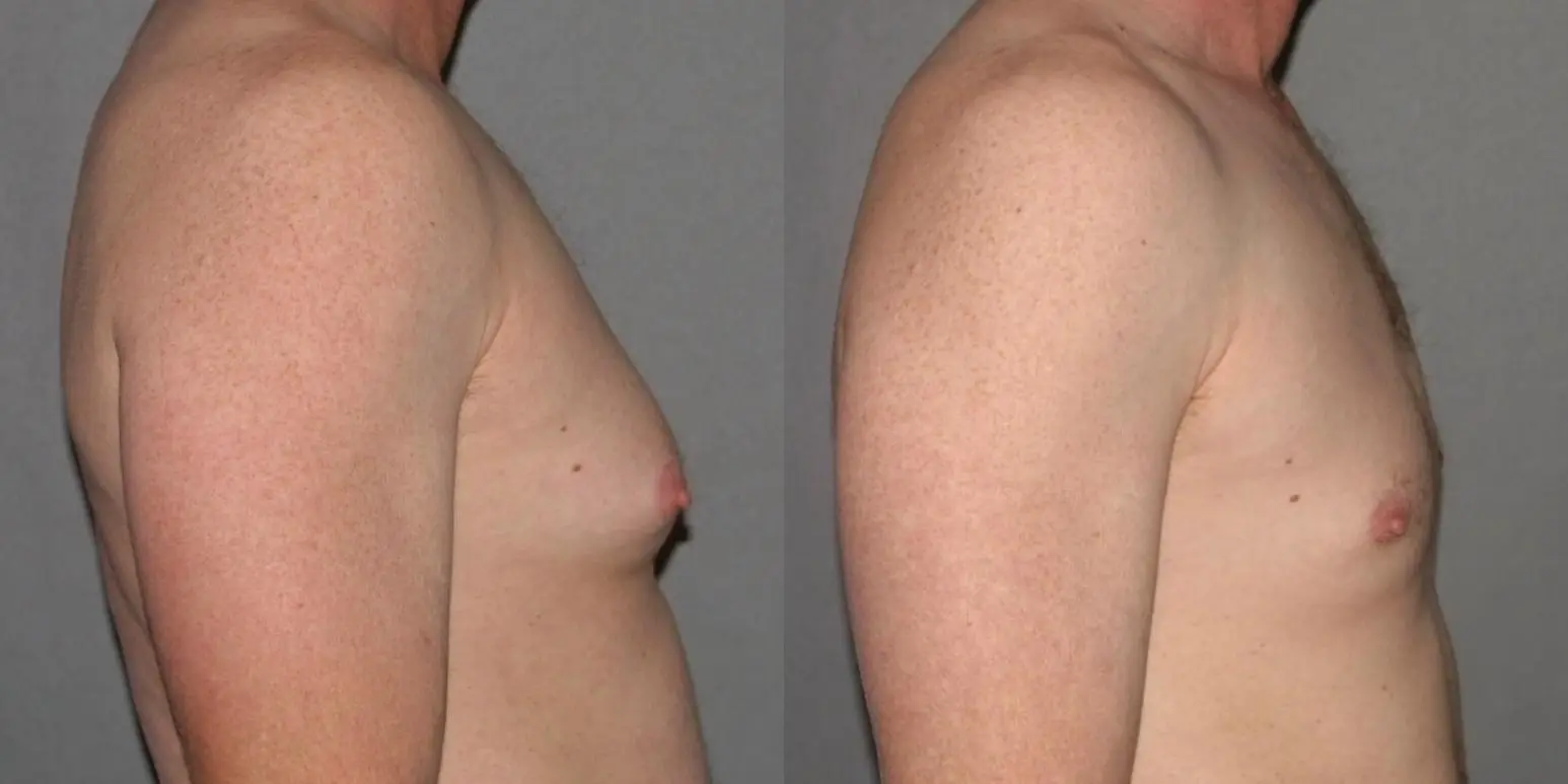 Liposuction For Men: Patient 2 - Before and After 3