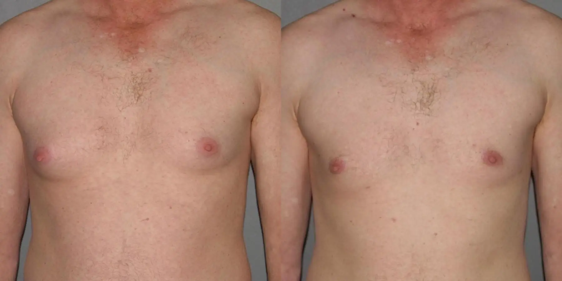 Liposuction For Men: Patient 2 - Before and After 1