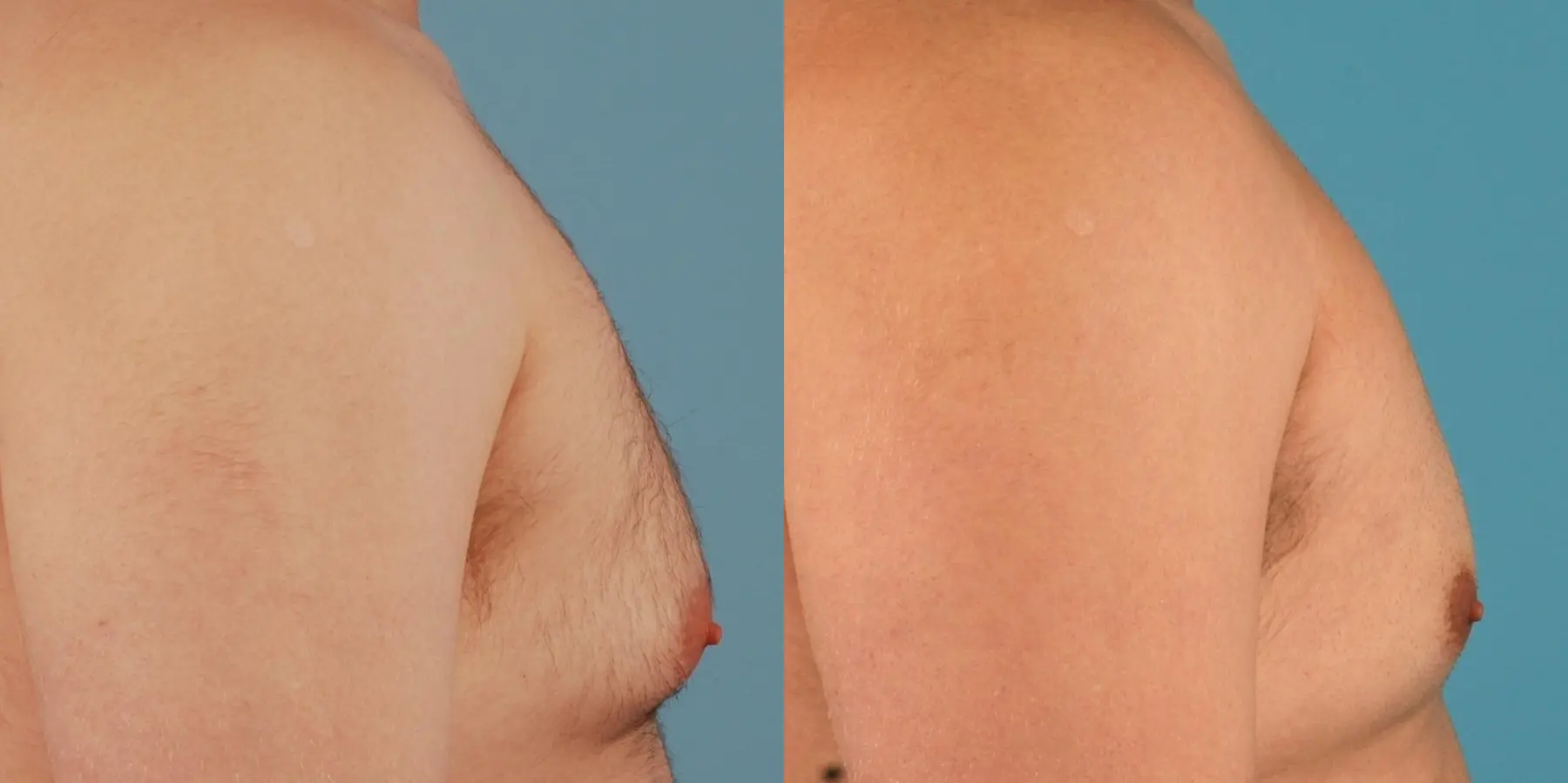 Liposuction For Men: Patient 3 - Before and After 5