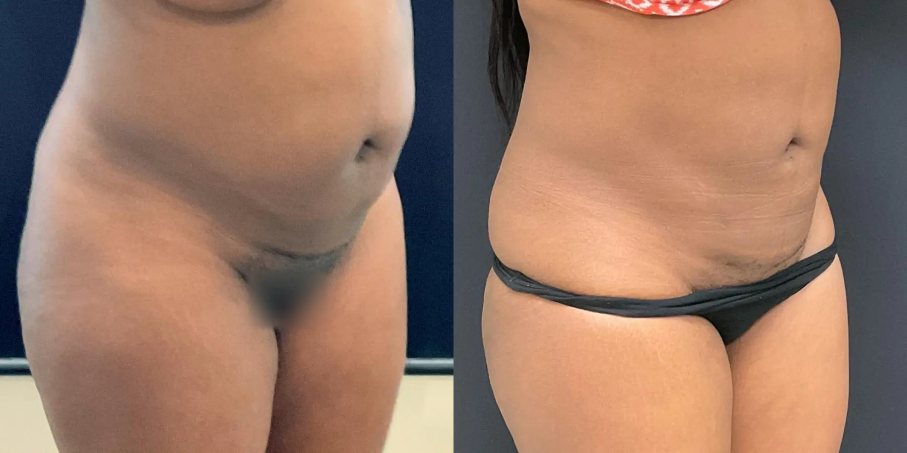 Liposuction: Patient 5 - Before and After 3