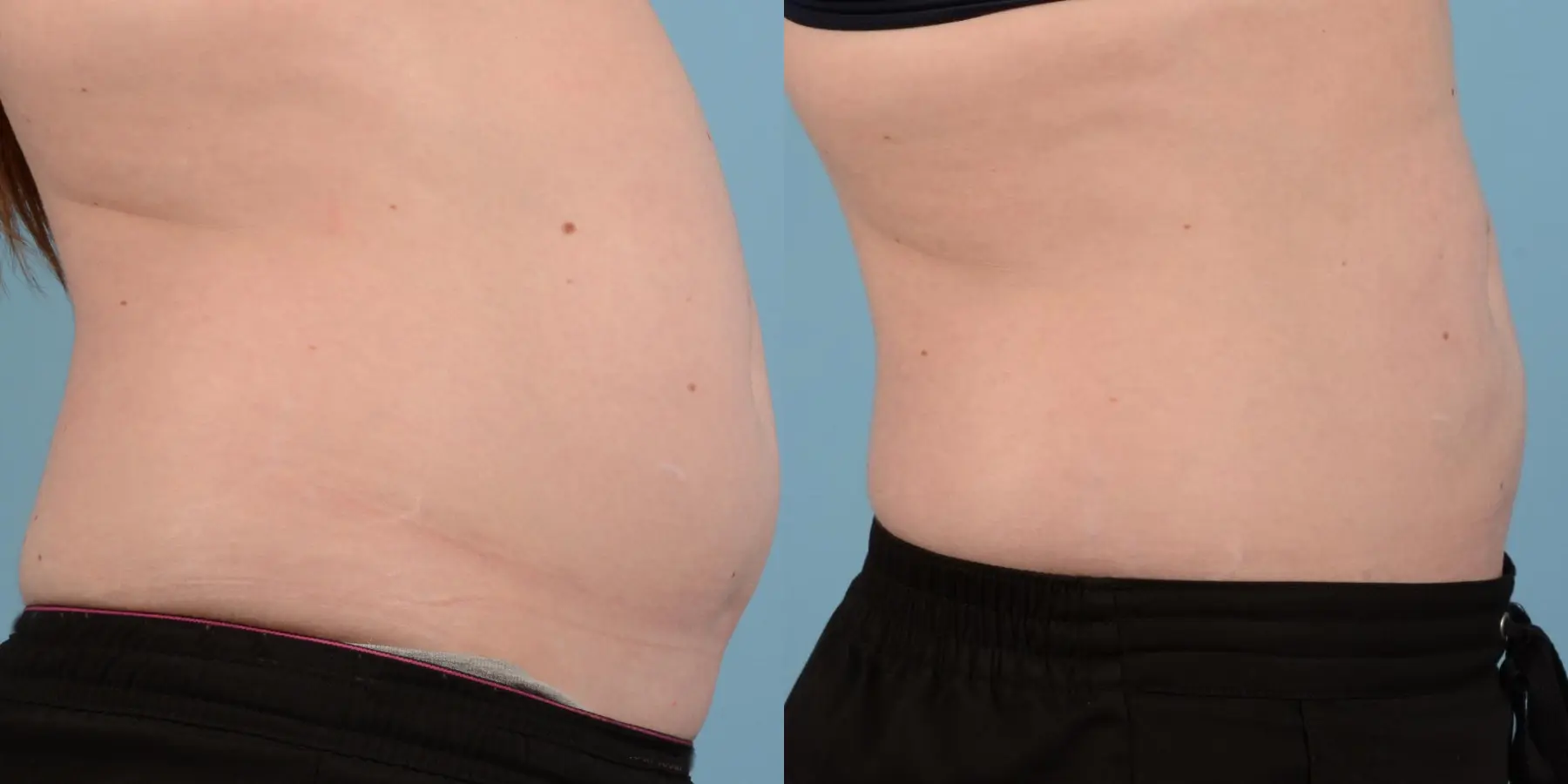 Liposuction: Patient 6 - Before and After 5