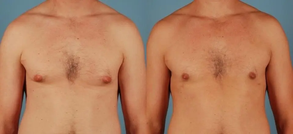 Male Breast Reduction: Patient 6 - Before and After 1