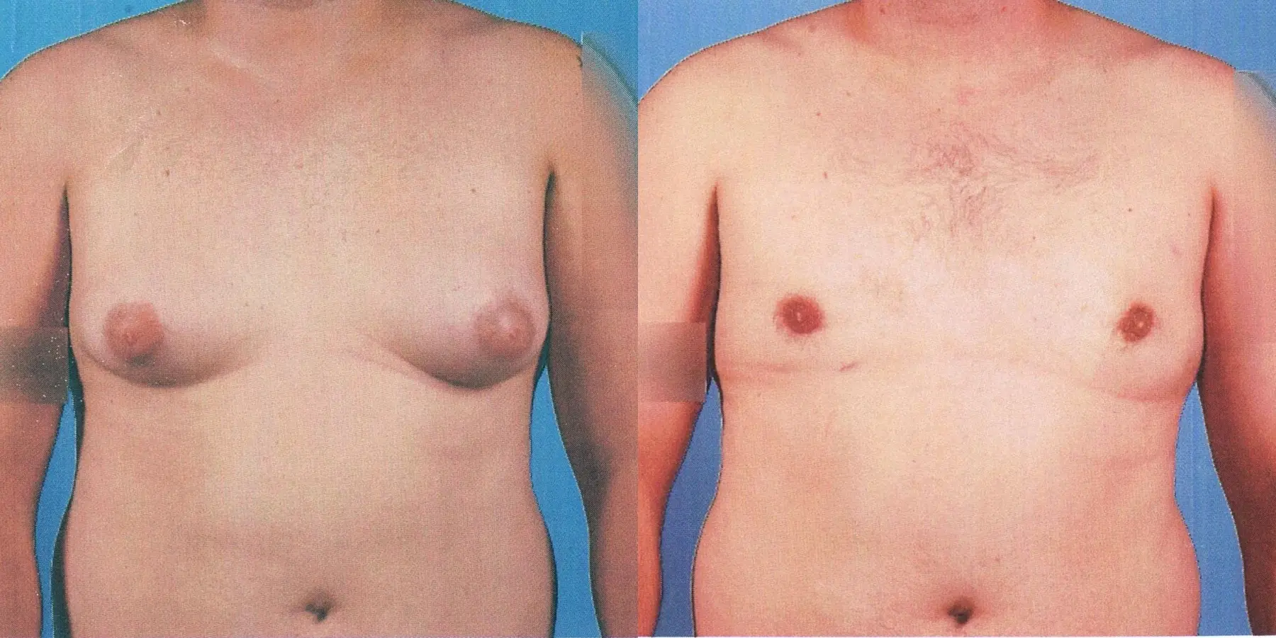 Male Breast Reduction: Patient 3 - Before and After 1