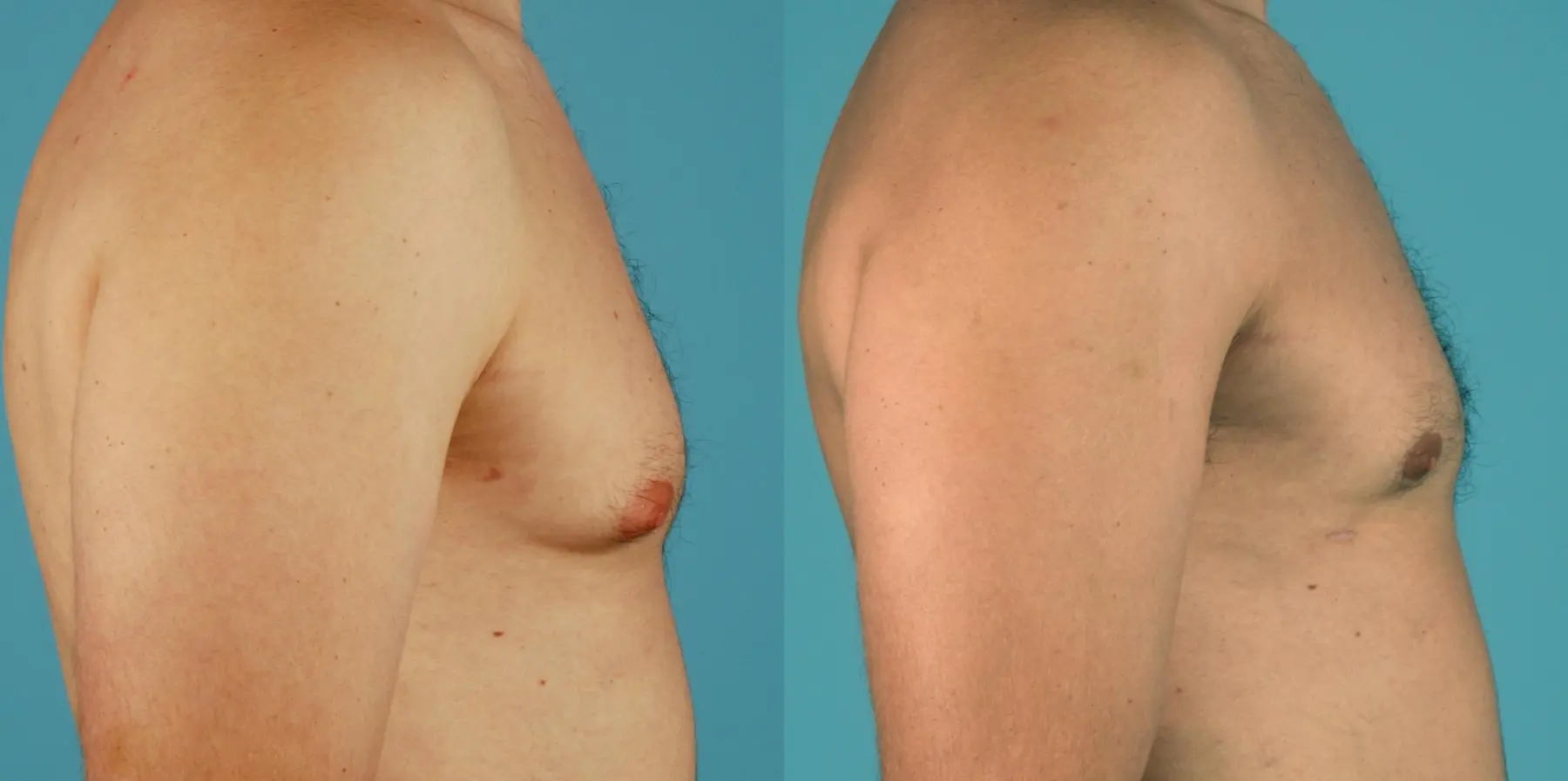 Male Breast Reduction: Patient 6 - Before and After 3