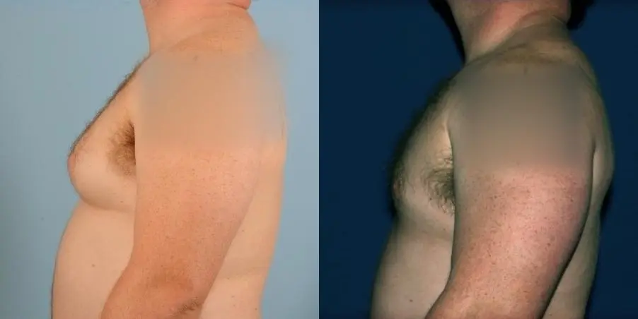 Male Breast Reduction: Patient 4 - Before and After 1