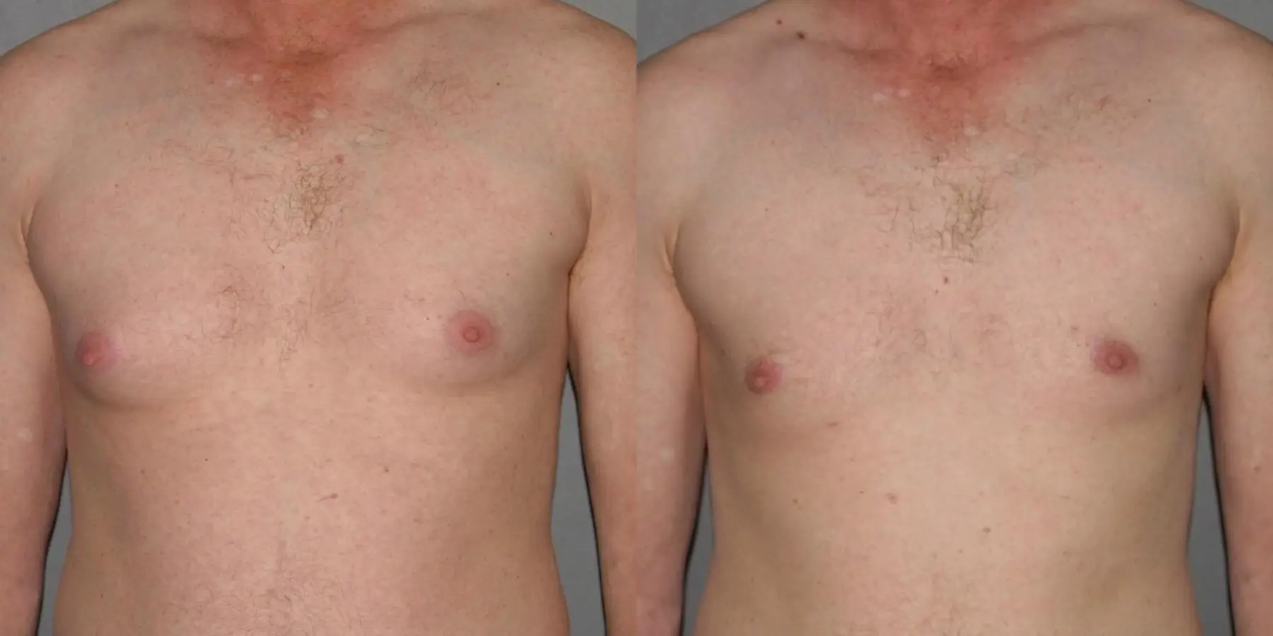 Male Breast Reduction: Patient 2 - Before and After 1