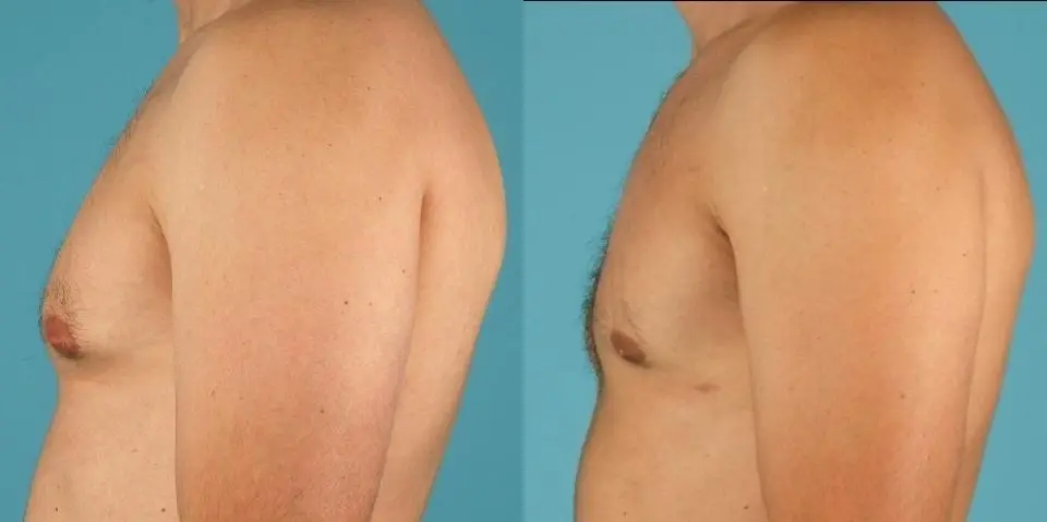 Male Breast Reduction: Patient 6 - Before and After 2