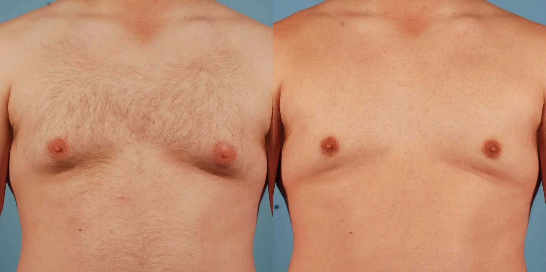 Male Breast Reduction: Patient 5 - Before and After 1