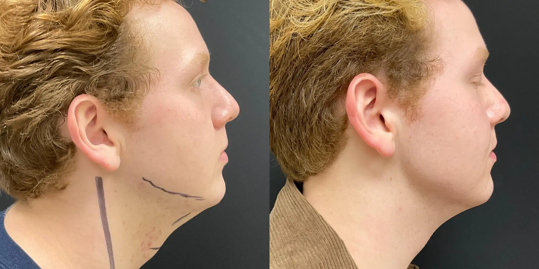 Morpheus8 For Men: Patient 1 - Before and After 1