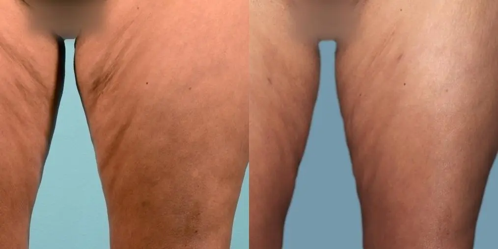 Skin Tightening: Patient 7 - Before and After  