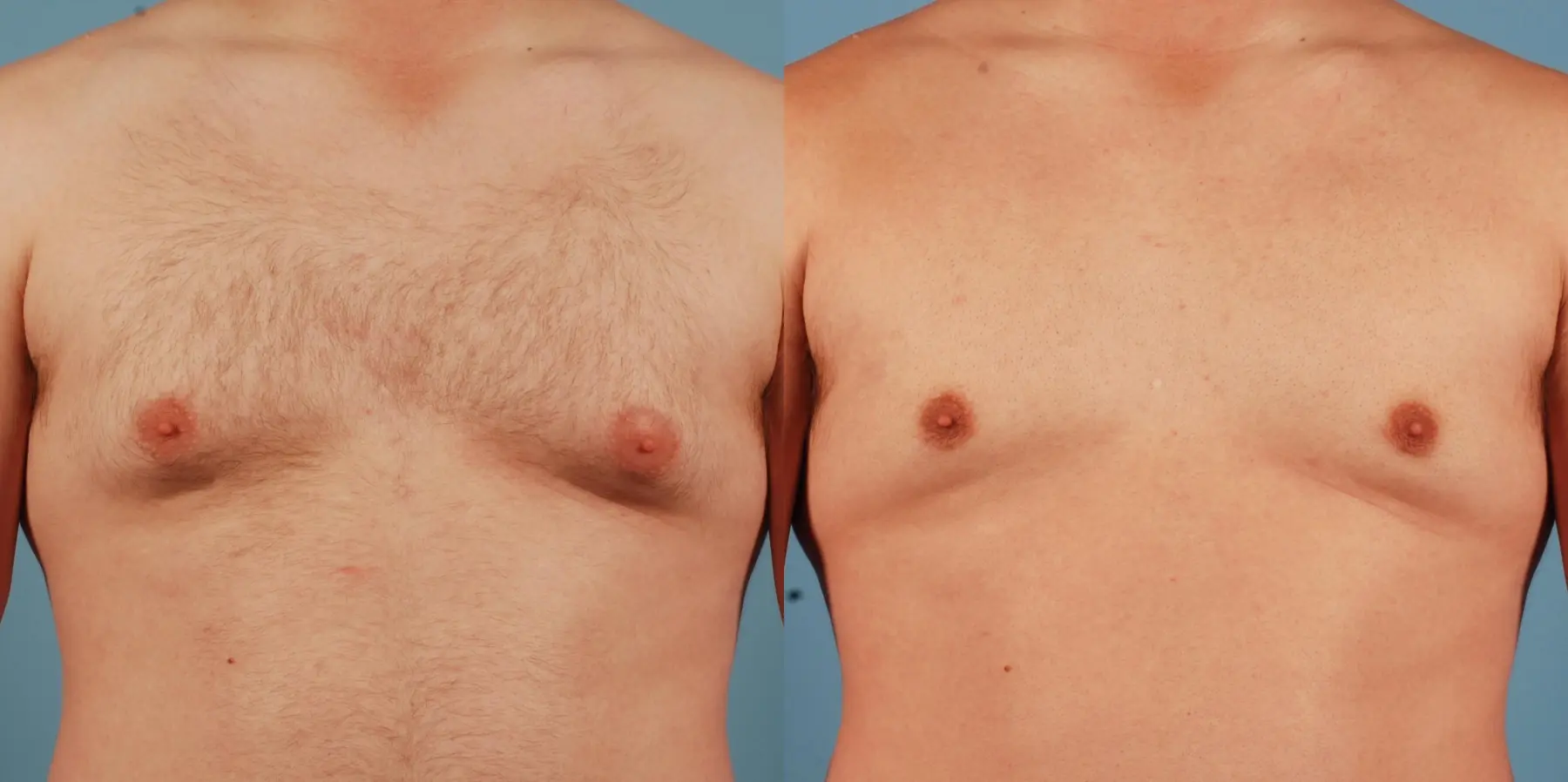 Skin Tightening For Men: Patient 4 - Before and After 1