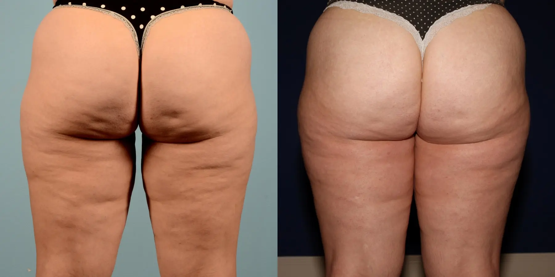 Skin Tightening: Patient 6 - Before and After  