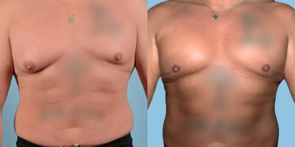 Skin-tightening-for-men: Patient 5 - Before and After  