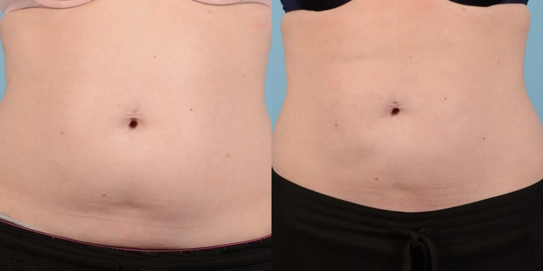 Skin Tightening: Patient 2 - Before and After 1