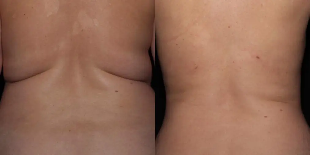 Skin Tightening: Patient 8 - Before and After 1