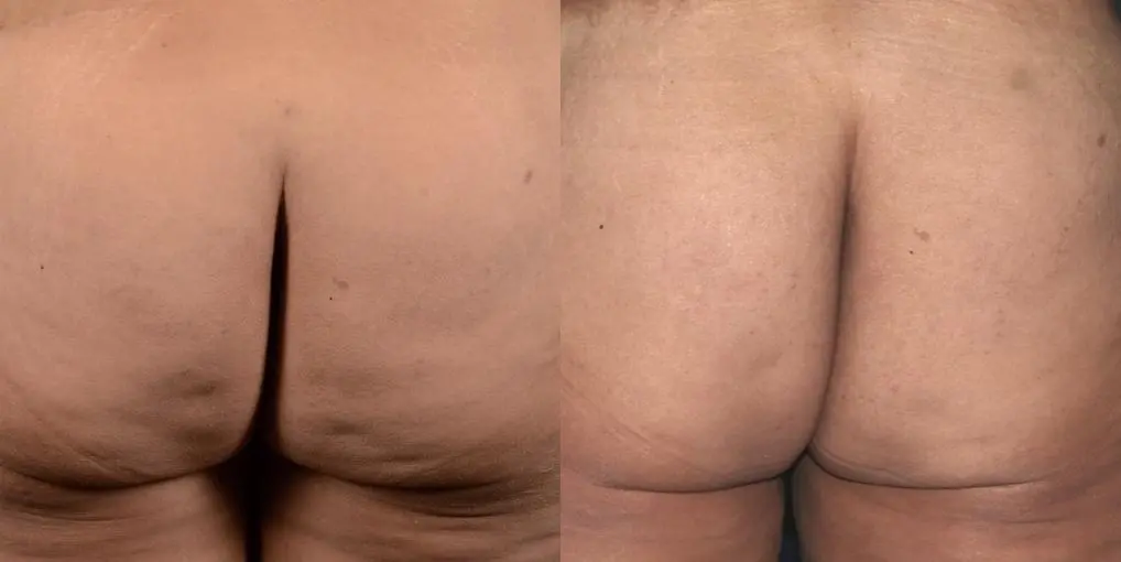 Skin Tightening: Patient 7 - Before and After 2