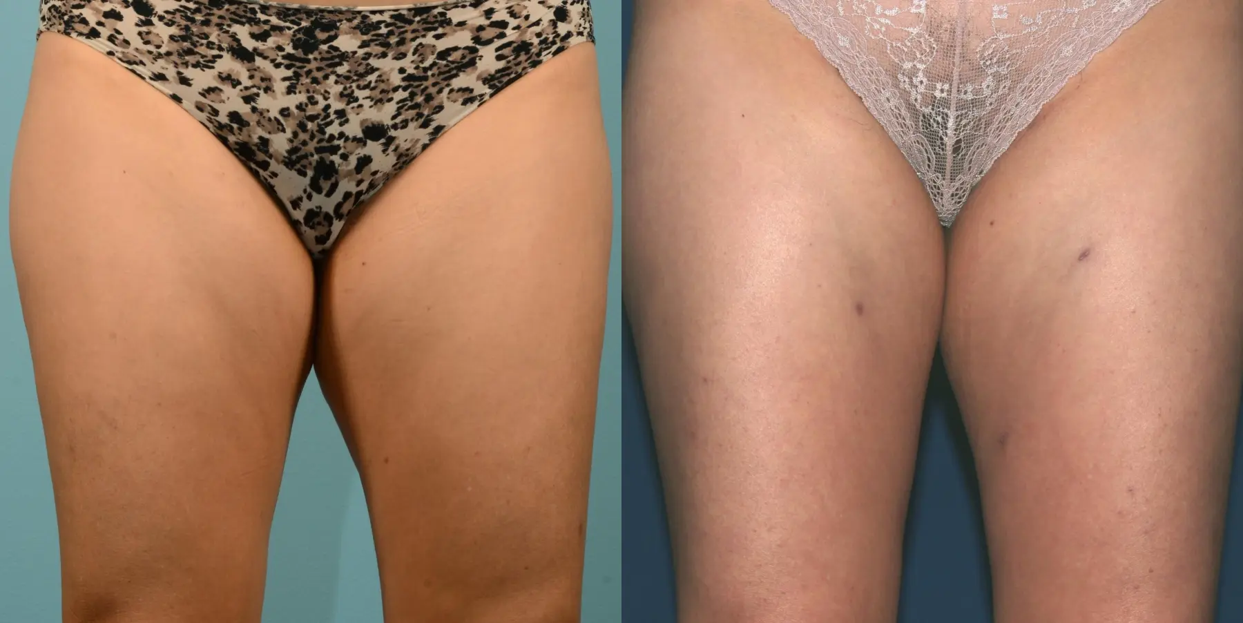 Skin Tightening: Patient 4 - Before and After 1