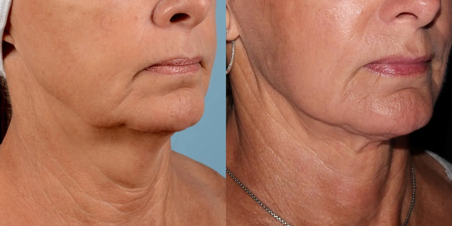 Skin Tightening Face: Patient 5 - Before and After 3