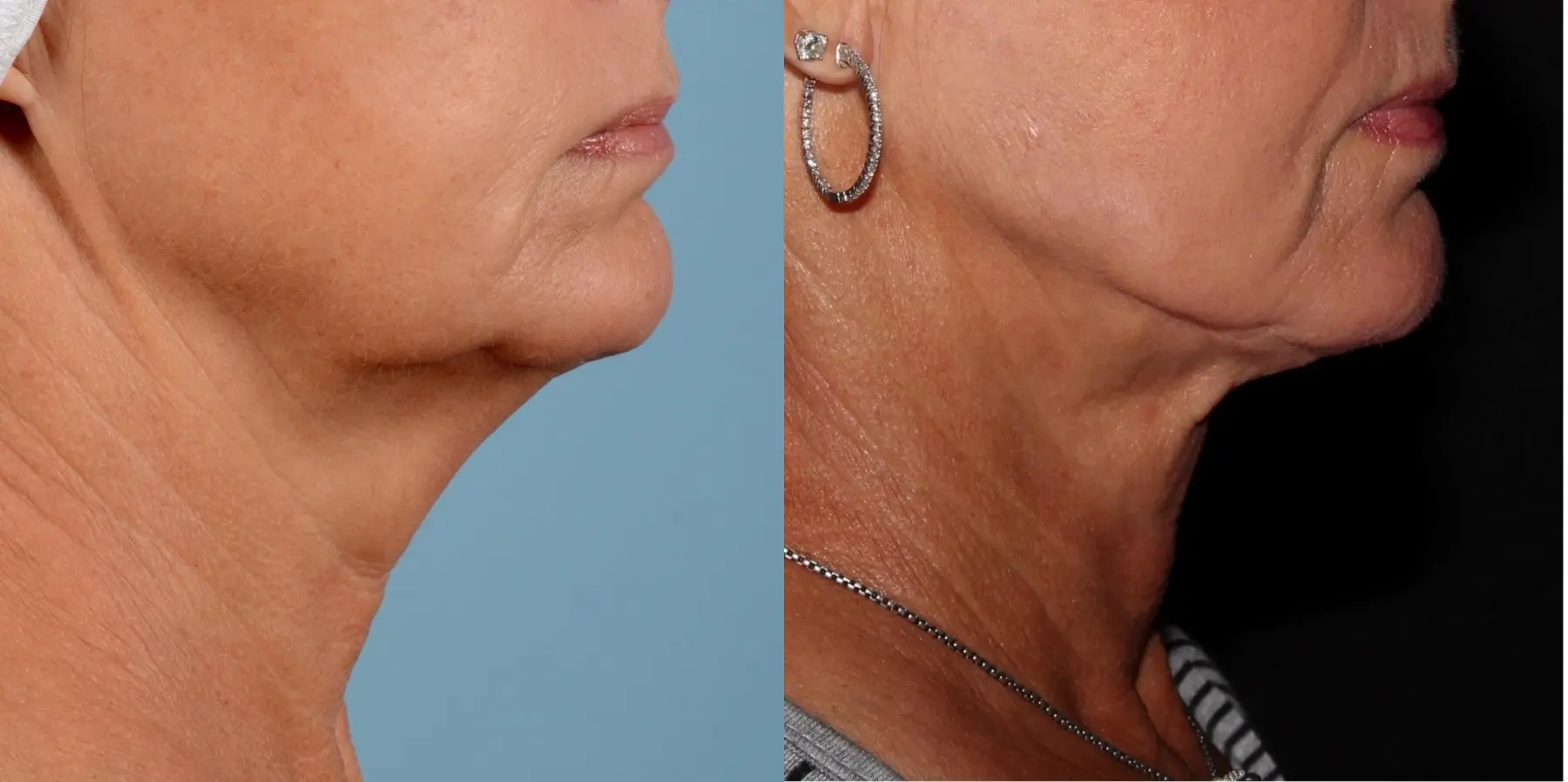 Skin Tightening Face: Patient 5 - Before and After 1