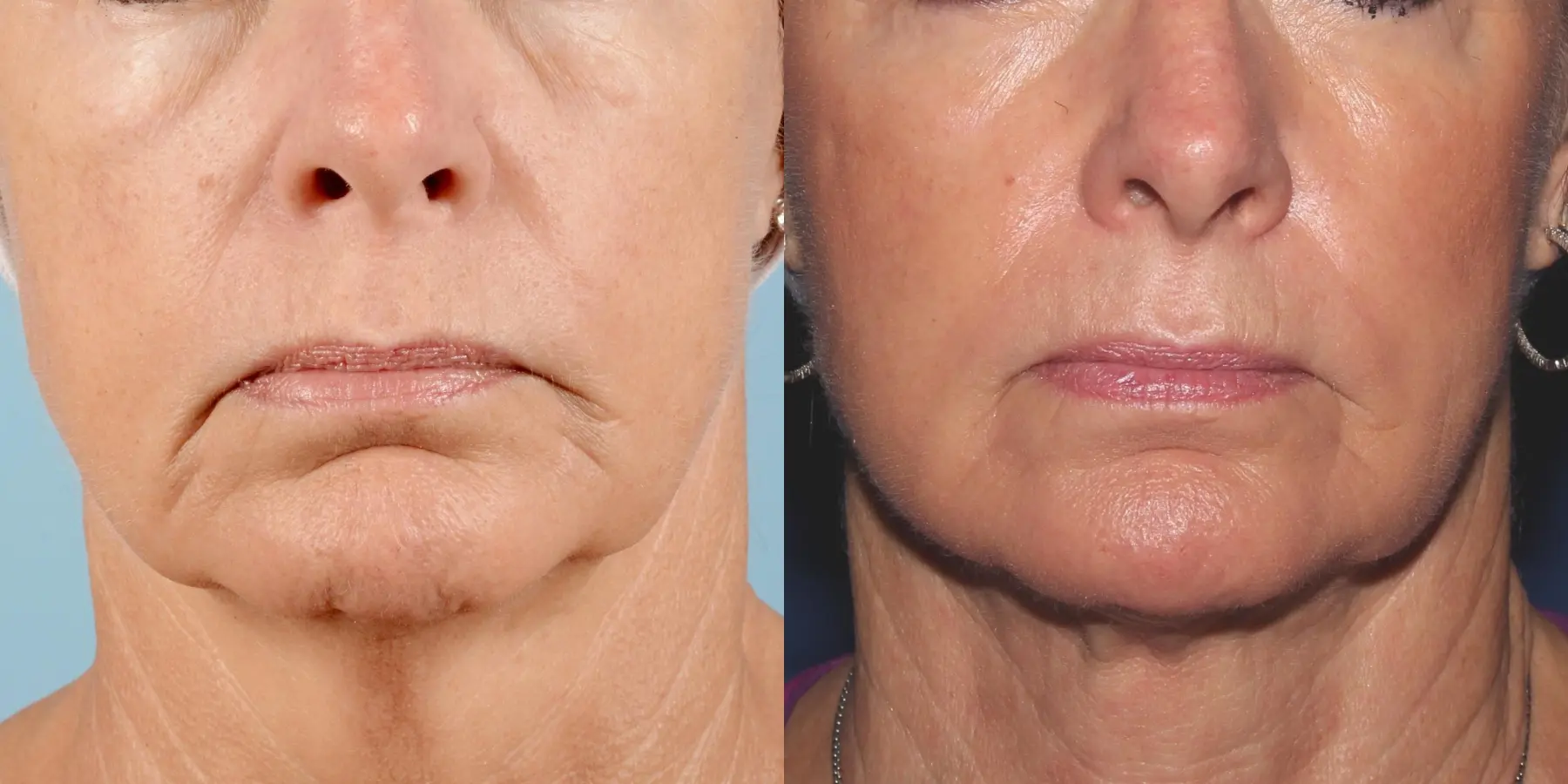 Skin Tightening Face: Patient 5 - Before and After 5