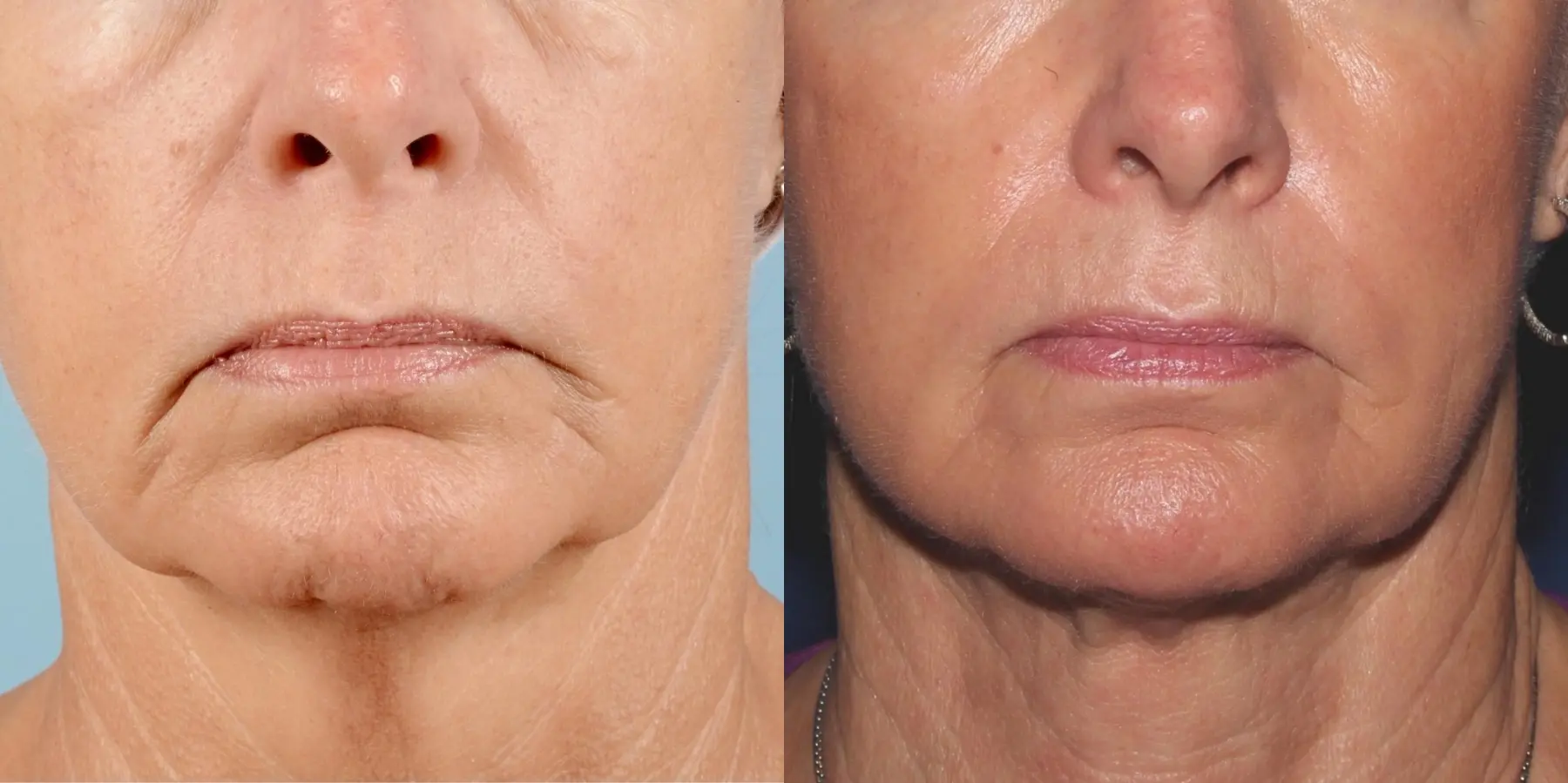 Skin Tightening Face: Patient 1 - Before and After  